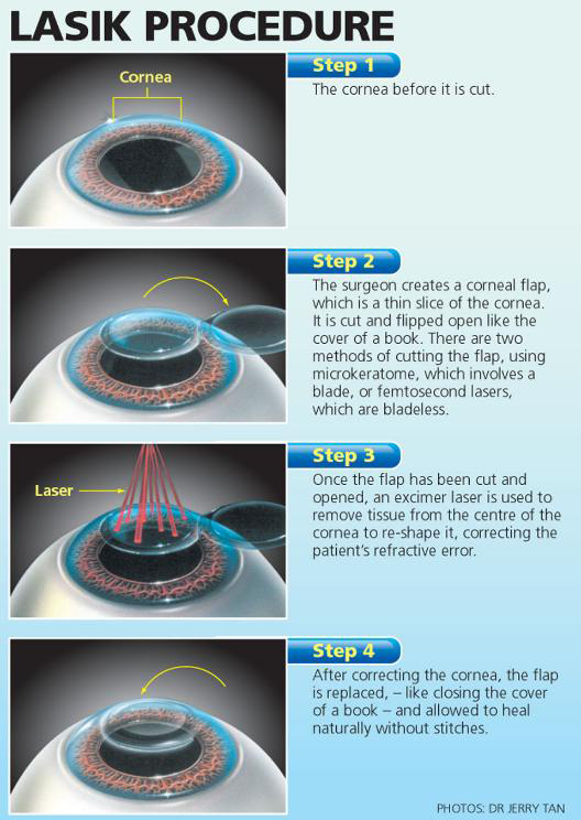 the-mystery-behind-lasik-eye-surgery-the-adams-kilt