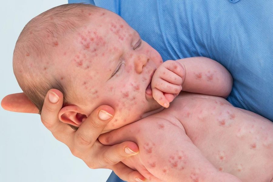 A baby infected with measles.